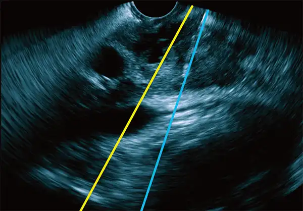 19 Ga针 19 Ga needle