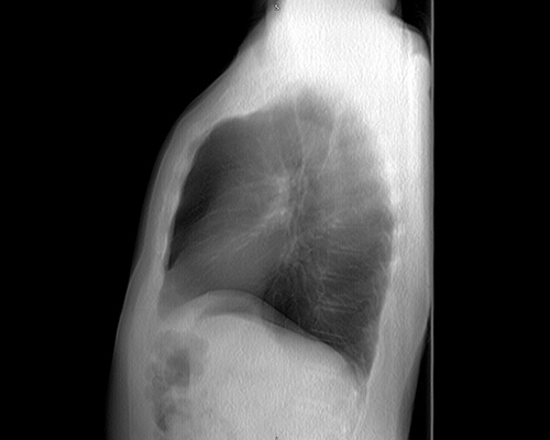 Lateral
