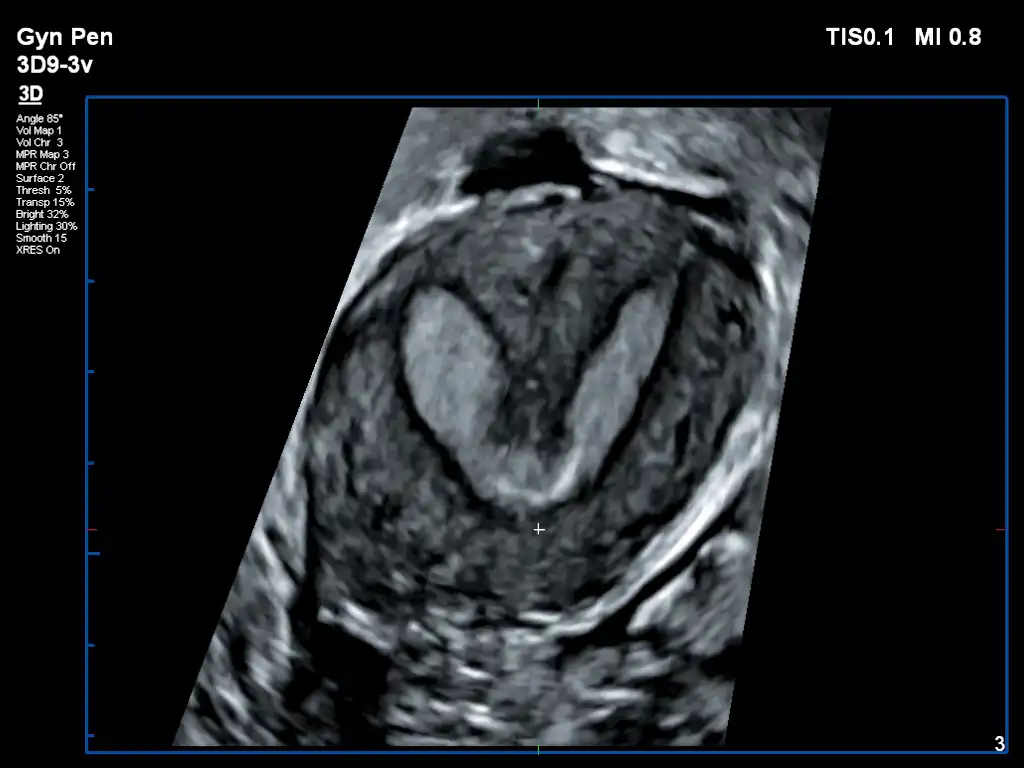 3D9-3v容积探头显示宫内膜三维成像