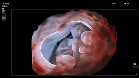 3D9-3v Fetal Imaging with GlassVue