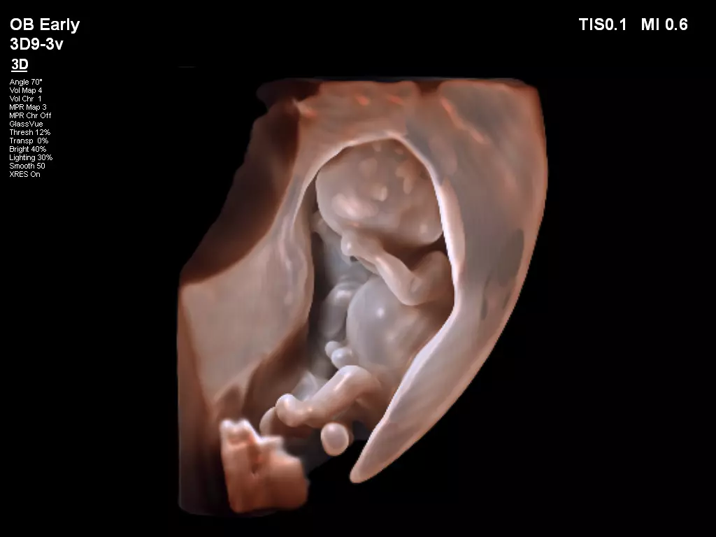 3D9-3v 3D TrueVue Fetal Imaging