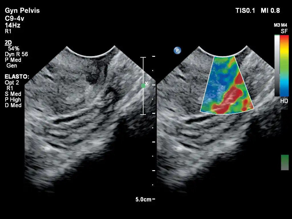 应变弹性成像检测子宫硬度
