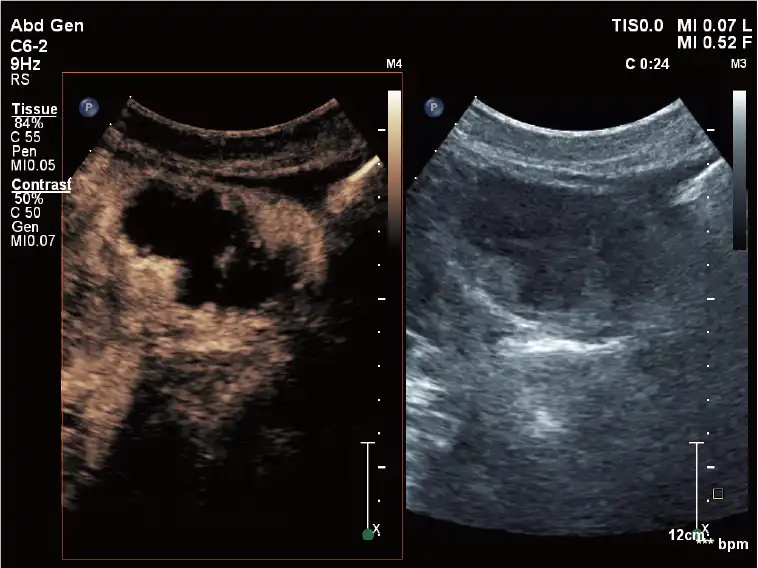 超声造影 超声造影
