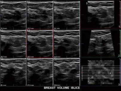乳房体积切片 乳房体积切片