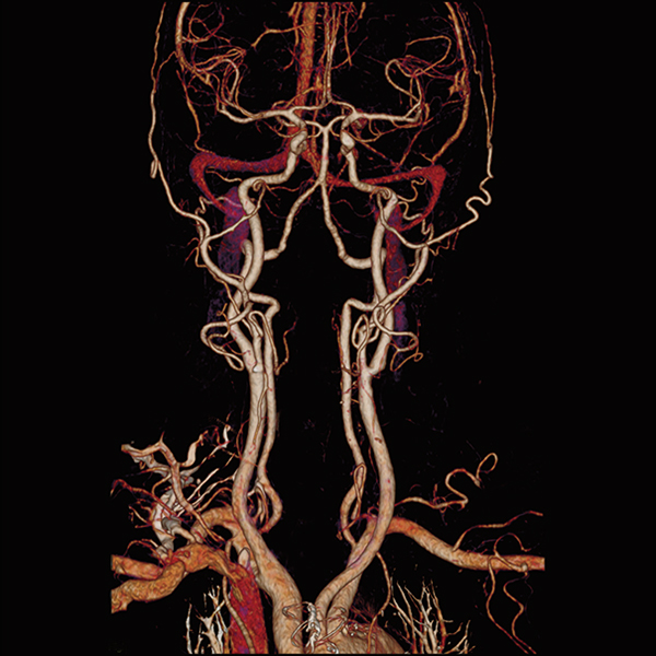 Angiography SURESubtraction CT