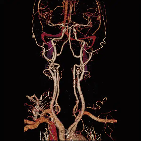 Angiography SURESubtraction CT