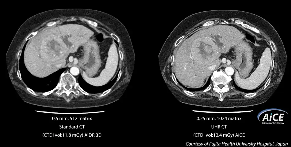 Advanced intelligent Clear-IQ Engine (AiCE)