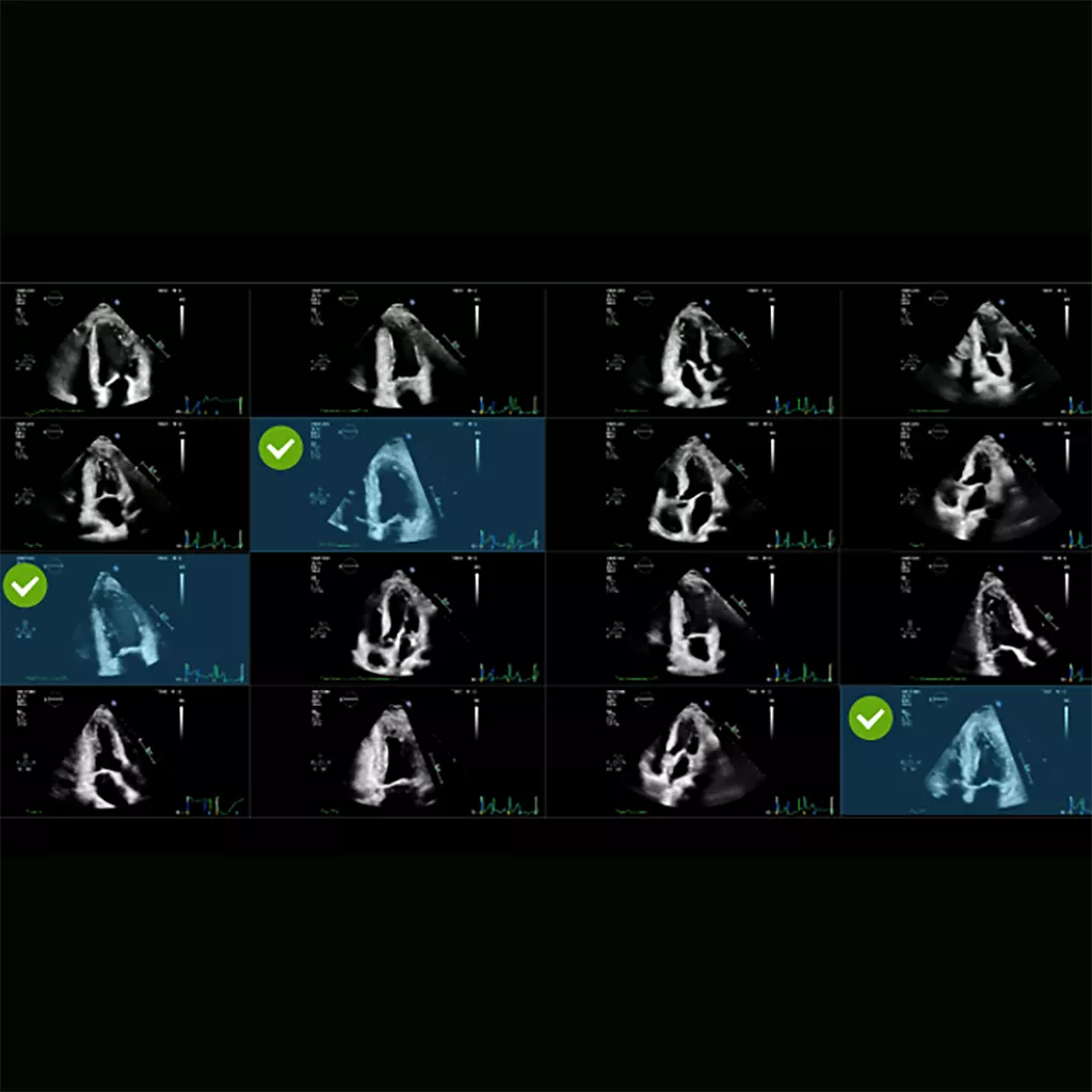 AutoStrain LV with automated EF and mid-layer strain
