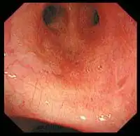 高分辨率支气管镜图像 高分辨率