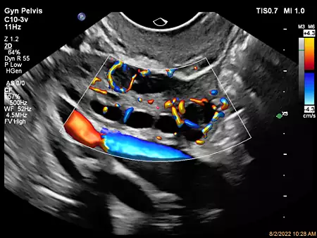 C10-3v Ovarian Perfusion with Flow Viewer