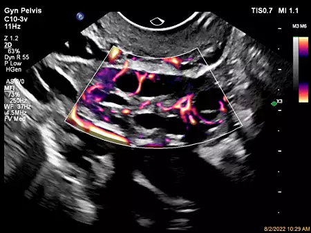 C10-3v Ovary with MicoFlow Imaging