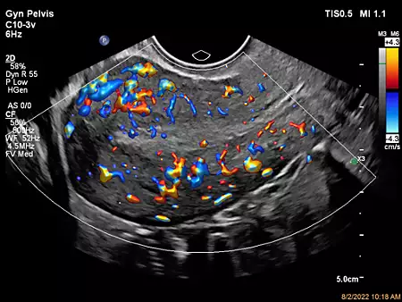 C10-3v Uterus with Flow Viewer