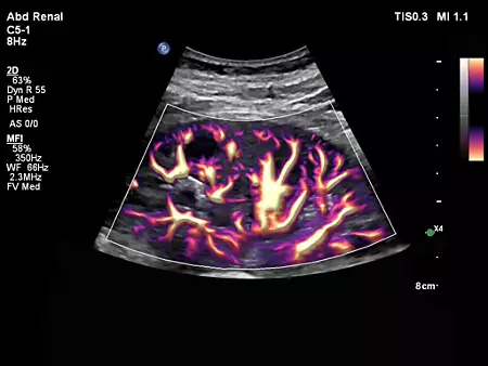 C5-1 Abdomen Renal Perfusion with MFI HD