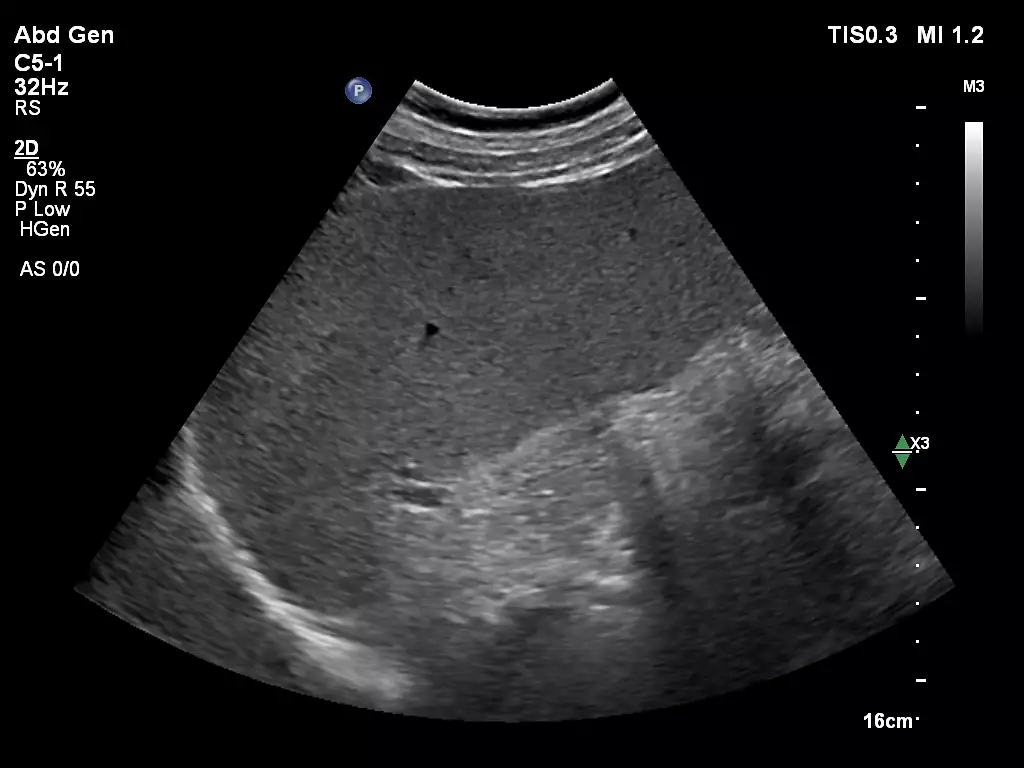 C5-1 Abdomen Spleen Imaging