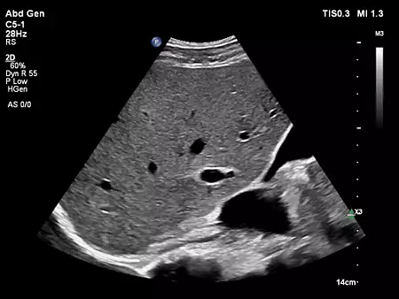 C5-1 Abdomen