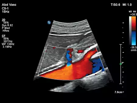 C5-1 Abdominal Vascular