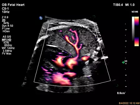 C5-1 Fetal Heart Pulmonary Vein with MFI HD (Micro Flow Imaging, High Definition)