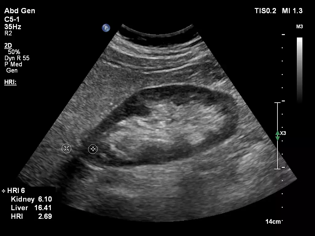 C5-1 Hepatic Renal Index (HRI)