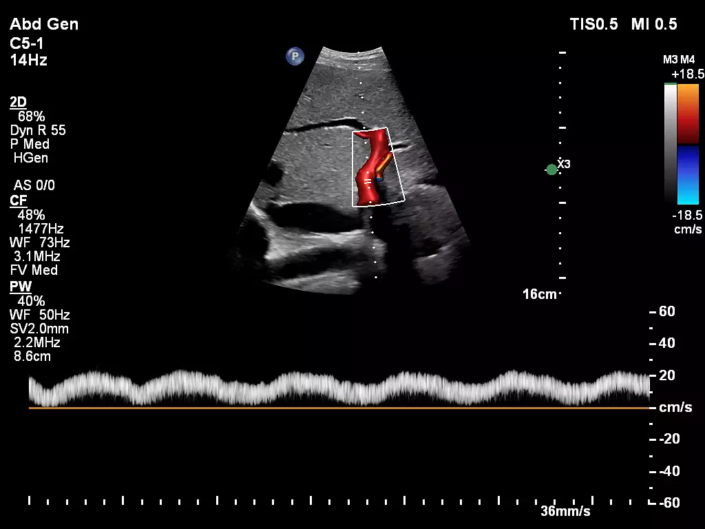 C5-1 Liver Doppler with FlowViewer