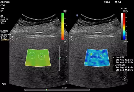 C5-1 Liver ElastQ with Confidence Map