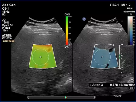 C5-1 Liver Fat Quantification