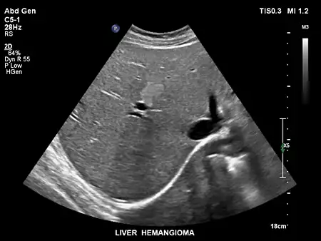 C5-1 Liver Hemangioma