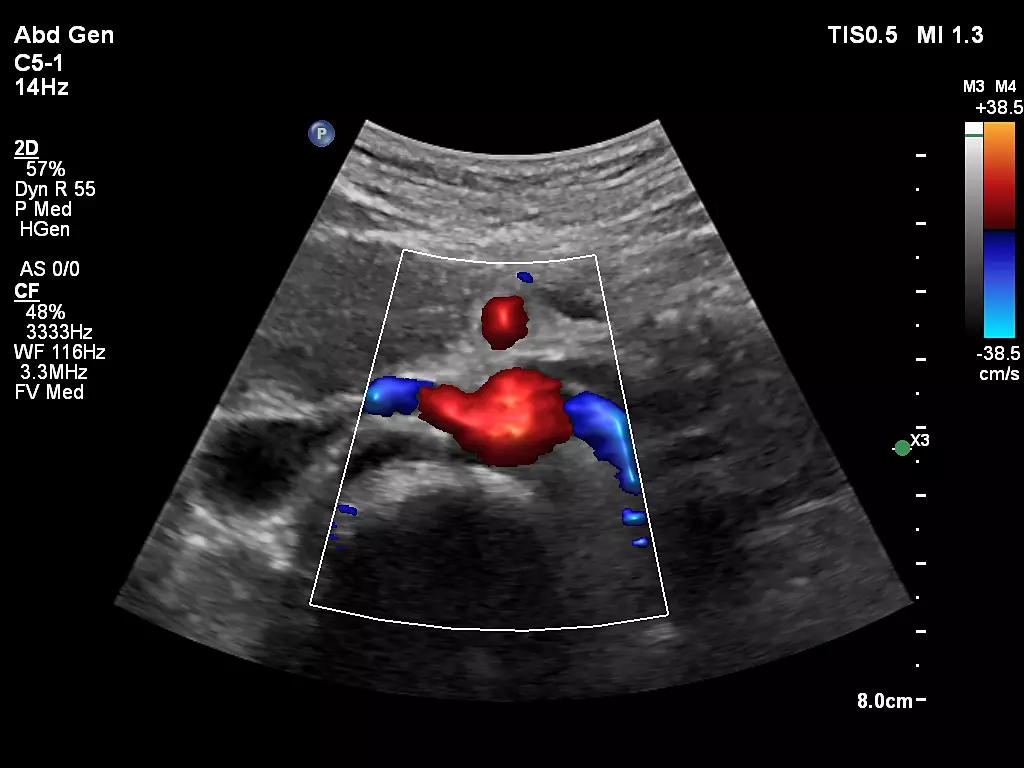 C5-1 Renal Artery Origin with FlowViewer