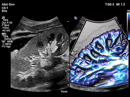 C5-1 Renal Perfusion with MFI Flow Viewer