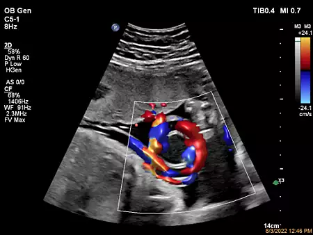 C5-1 Umbilical Cord Color Flow with Flow Viewer