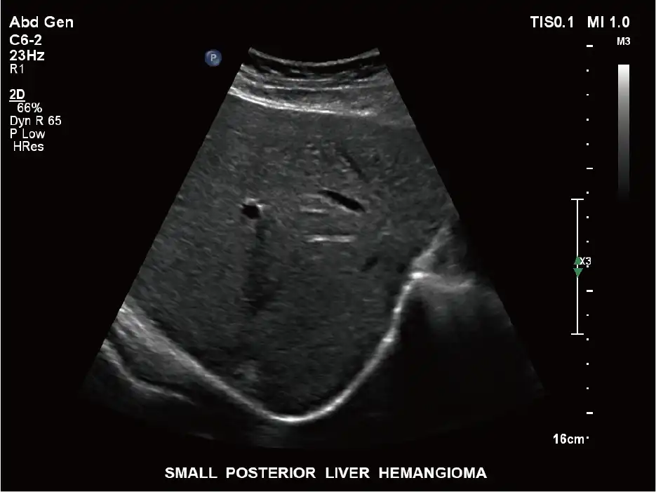 C6-2探头显示肝后叶血管瘤