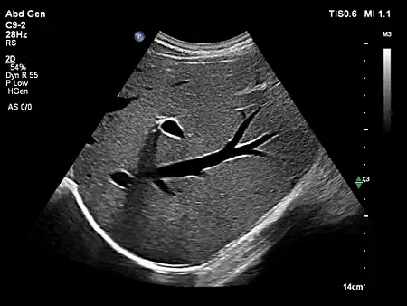 C5-1 Liver Doppler with FlowViewer
