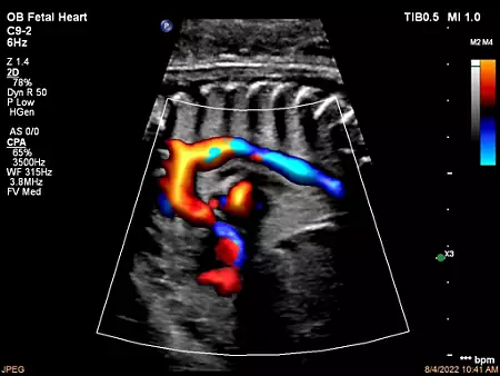 C9-2 Aortic Arch with FlowViewer