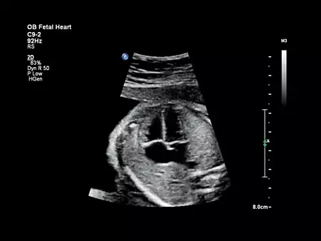 C9-2 Fetal heart
