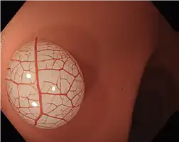 白光 White Light Normal Focus