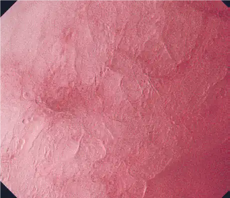 非肿瘤(食道) 非肿瘤(食道)