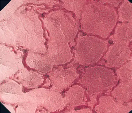 肿瘤(食道) 肿瘤(食道)