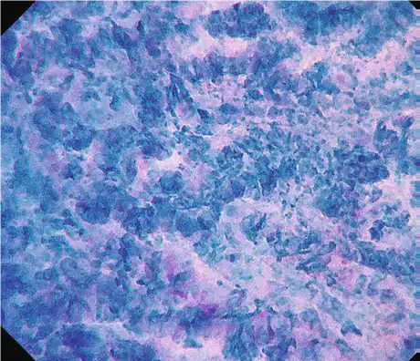 肿瘤(食道) 肿瘤(食道)