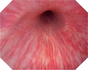 Already under white light, the CYF-VH allows a wider view and detailed vision, which is primarily important for all bladder cancer follow-up cystoscopies.