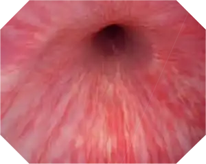 Already under white light, the CYF-VH allows a wider view and detailed vision, which is primarily important for all bladder cancer follow-up cystoscopies.