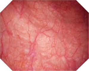 The cristal-clear view in the urethra improves detection and diagnosis of suspicious areas.