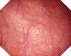 The cristal-clear view in the urethra improves detection and diagnosis of suspicious areas.