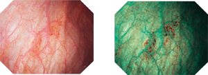 NBI (Narrow Band Imaging)