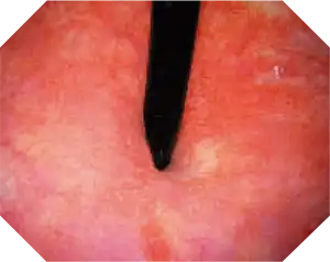 Suspicious regions within the delicate structures of the bladder neck can be easier identified with the help of the cristal-clear HD image of the CYF-VH.