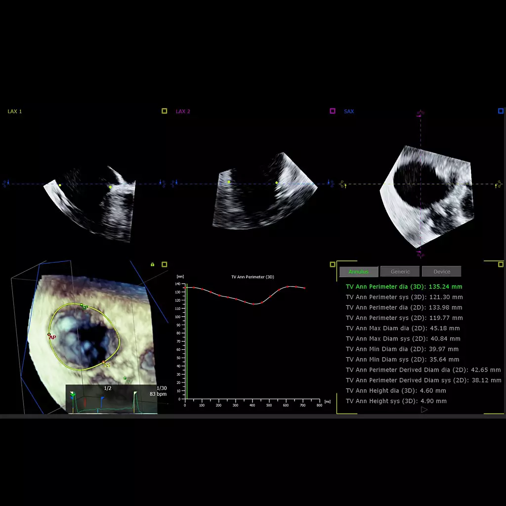 3D Auto Tricuspid Valve Quantification