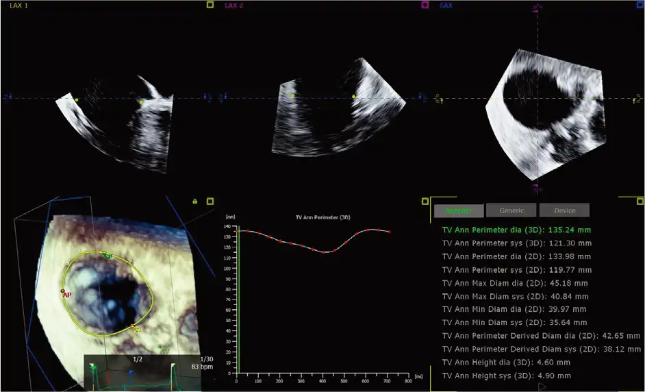 3D 自动三尖瓣定量