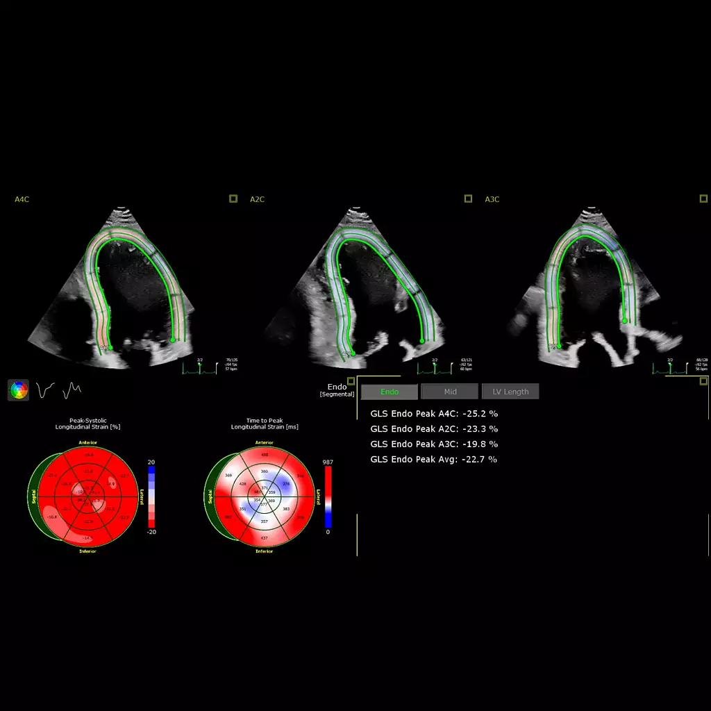 AutoStrain LV with automated EF and mid-layer strain