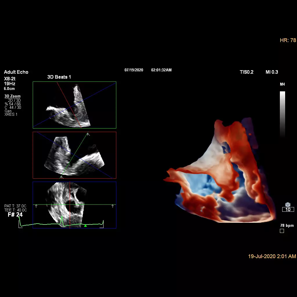 Ultrasound Left Atrial Appendage solution