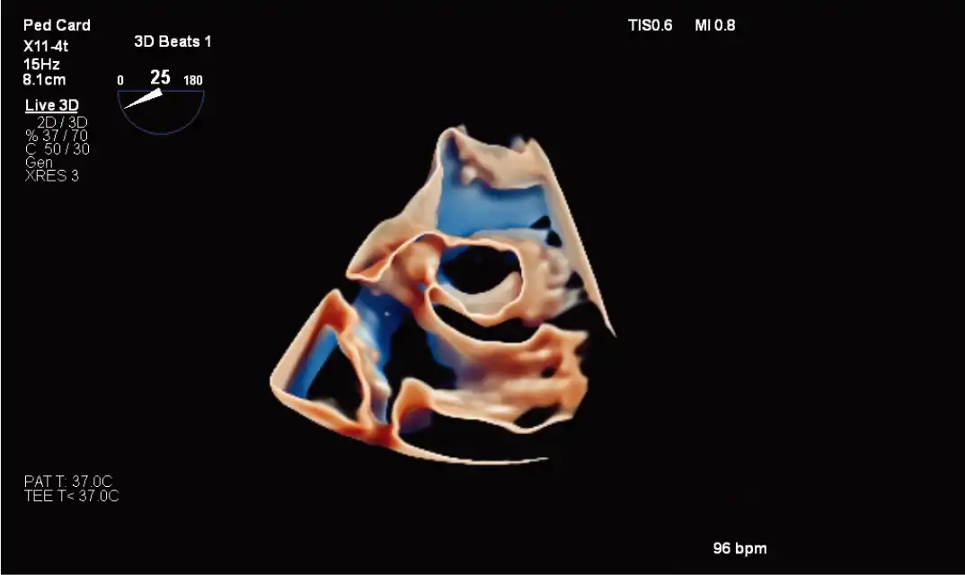 X11-4t 探头和 TrueVue 进行瓣下膜检查 X11-4t 探头和 TrueVue 进行瓣下膜检查