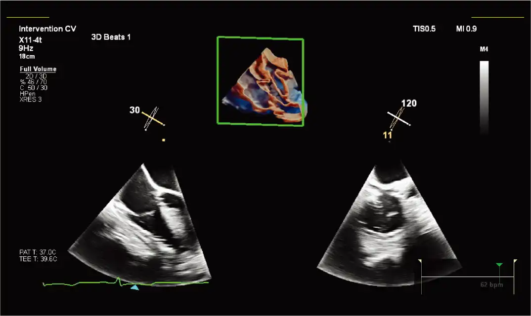 X11-4t 探头和 TrueVue Glass 进行三尖瓣 MPR 成像。 X11-4t 探头和 TrueVue Glass 进行三尖瓣 MPR 成像。