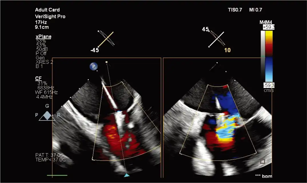 使用 VeriSight Pro 进行 xPlane 成像 使用 VeriSight Pro 进行 xPlane 成像